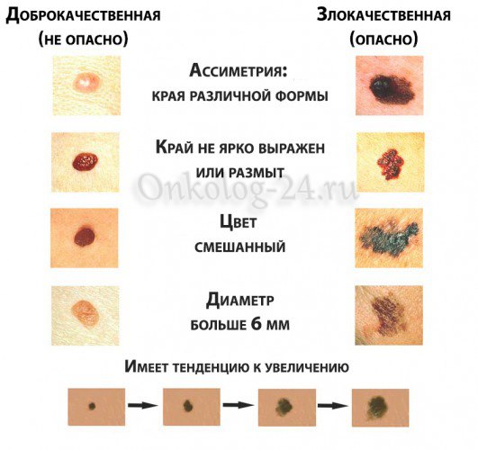 simptomy melanomy