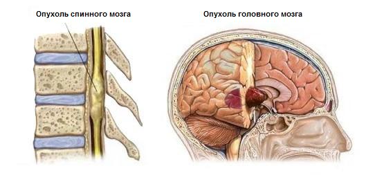 Классификация опухолей головного и спинного мозга