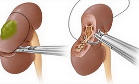 Лапароскопическая резекция почки