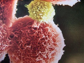 Немелкоклеточный рак легкого