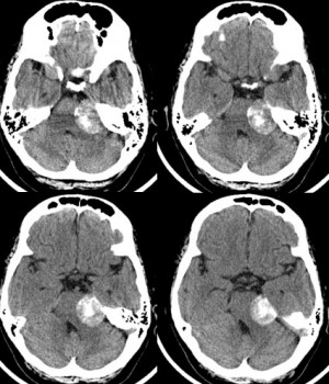 Невринома слухового нерва представлена на снимках КТ
