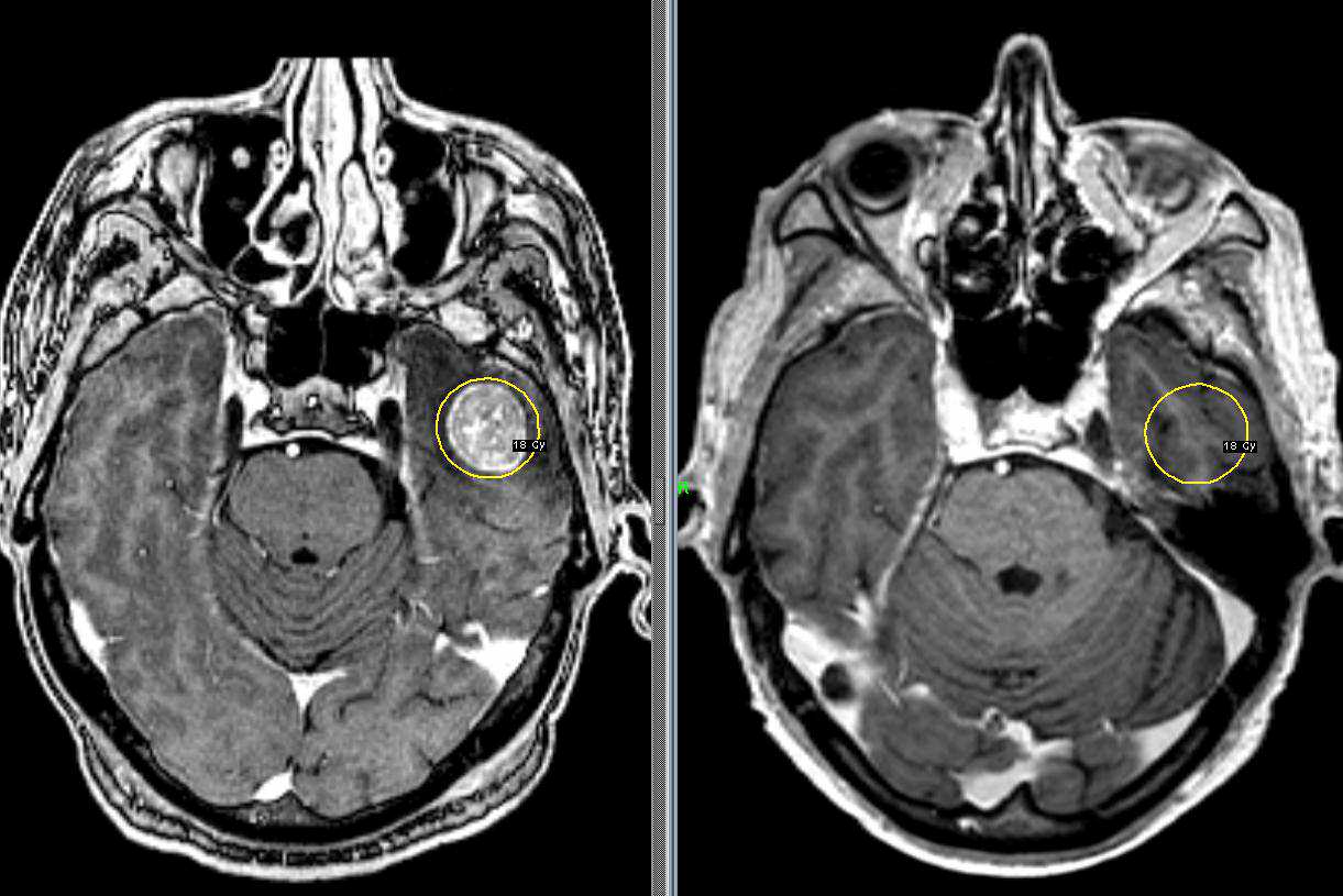 Снимок МРТ при раке головного мозга