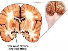 Первичный рак головного мозга