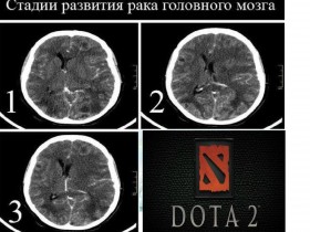 Стадии развития и распространения рака головного мозга