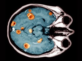 Рак головного мозга