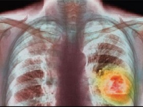 Рак легких: диагностика