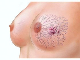 Рак молочной железы: фото 1