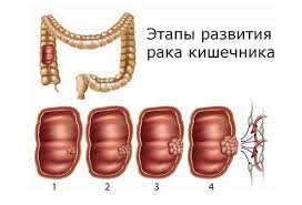 Рак толстого кишечника: стадии фото