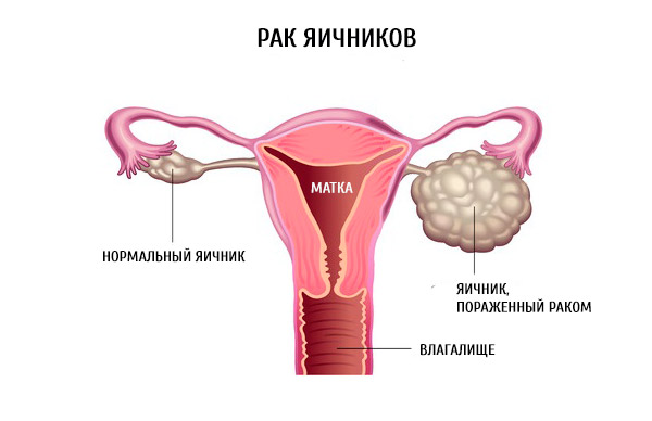 Увеличены яичники как лечить народными средствами Увеличены яичники как лечить народными средствами