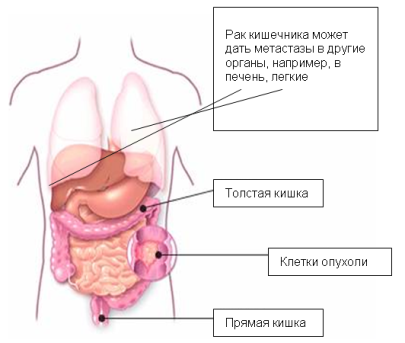 Рак кишечника с метастазами