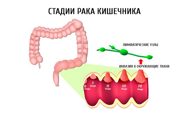 Как развивается рак кишечника?
