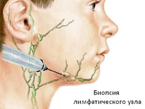 Диагностика подчелюстных лимфлузлов