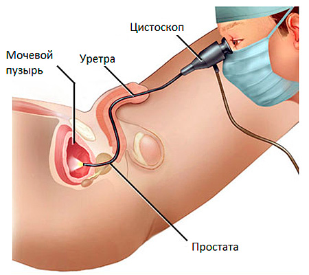 Цитоскопия
