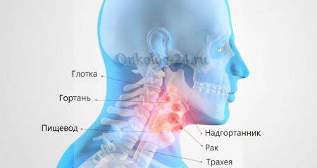 Рак гортани: симптомы и лечение