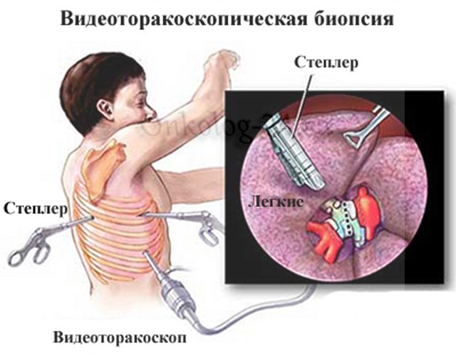 Videotorakoskopicheskaya biopsiya legkikh