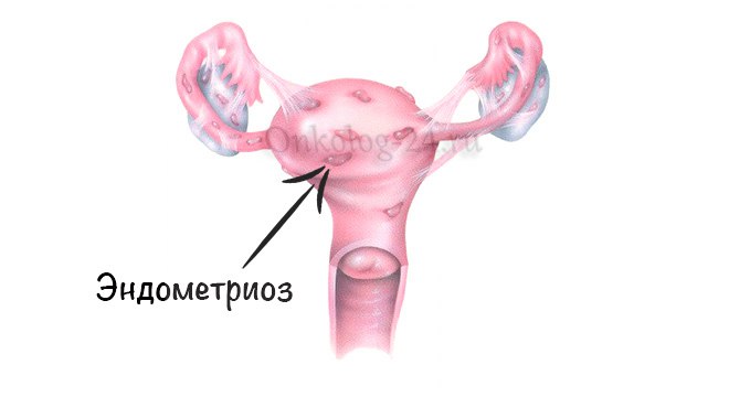 Endometrioz matki