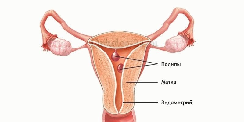 Fibroznyy polip endometriya